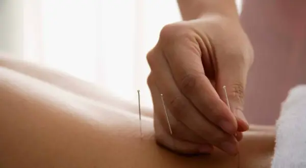 Nahaufnahme: Nadeln werden in die Haut eingeführt. Viele positive dry needling erfahrungsberichte bestätigen die Wirksamkeit.