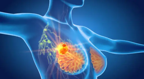 Anatomical view of a breast showing a tumor and affected wezly chlonne piersi.