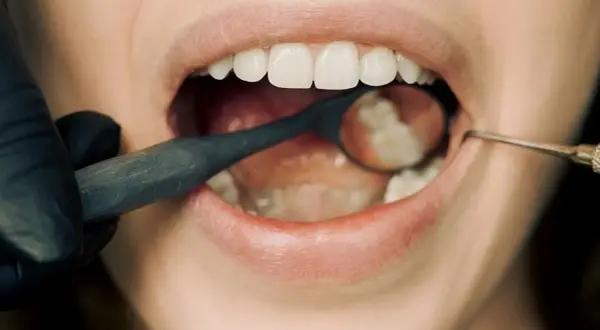 Badanie jamy ustnej, lustro dentystyczne odbija zęby, a narzędzie bada przyzębie.