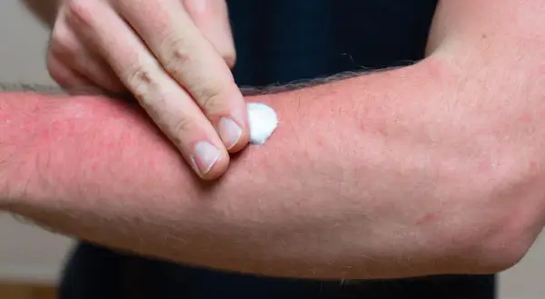 Mann trägt Salbe auf stark geröteten Arm auf, der unter brennender Haut leidet.