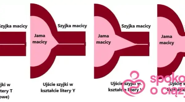 Skracanie szyjki macicy przed porodem: objawy, tempo, kiedy do lekarza?