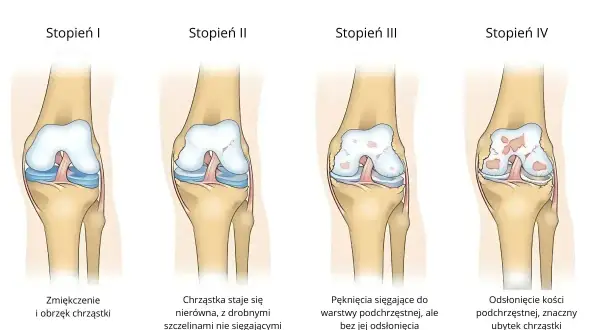 Klasyfikacja Outerbridge'a pokazuje cztery stopnie chondromalacji rzepki: od zmiękczenia chrząstki (stopień I) do odsłonięcia kości (stopień IV).