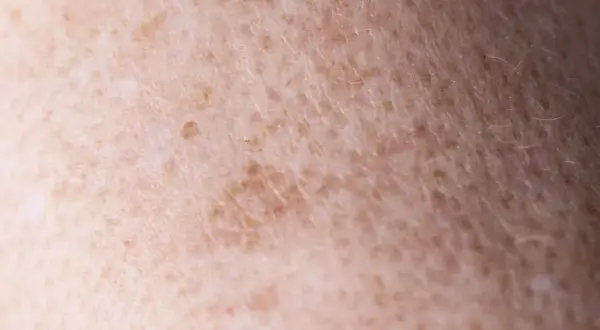 Zbliżenie na skórę z przebarwieniami, gdzie widać nierównomierne rozmieszczenie melaniny. To właśnie melanina co to jest, decyduje o kolorze skóry.