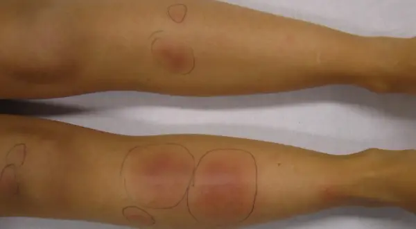 Gambe con segni di pizzichi, arrossamenti e gonfiori evidenziati da cerchi a matita.