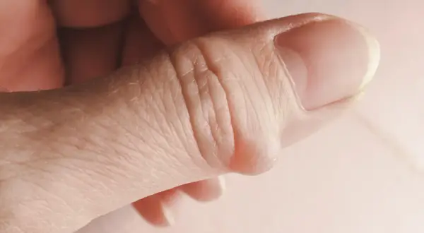 Nahaufnahme eines Daumens mit einem sichtbaren Ganglion am Finger.