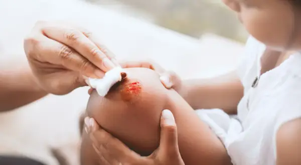 Mano limpia una herida en la rodilla de un niño con clorhexidina, cuidando las pequeñas lesiones.