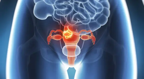 Illustration des weiblichen Beckens mit Fokus auf die Gebärmutter, die einen Tumor zeigt. Dies illustriert die Leitlinie Endometriumkarzinom.