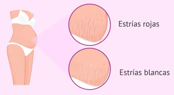 Ilustración de abdomen de embarazada con primeros planos de estrías rojas y blancas, mostrando las marcas comunes del embarazo.