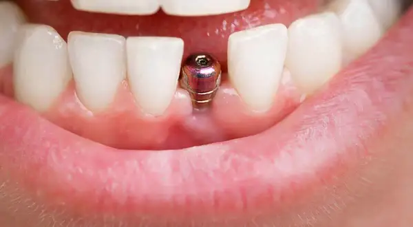 Implant zęba przed i po: metalowy filar wystaje z dziąsła, czekając na koronę.