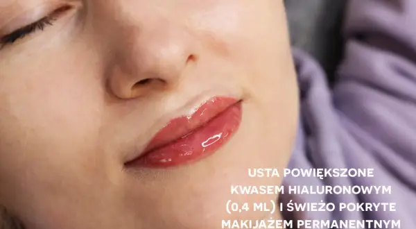 Usta po powiększeniu kwasem hialuronowym i makijażu permanentnym, z błyszczącym wykończeniem.