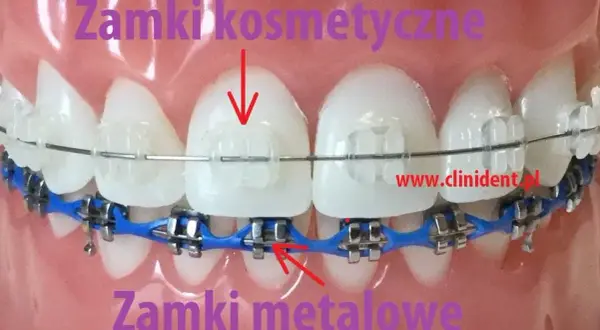 Aparat na zęby: zobacz, jak wygląda! Od metalu po niewidoczne