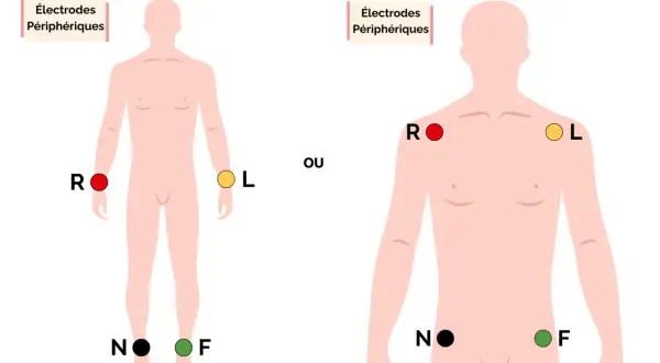 Schéma montrant le placement des électrodes périphériques pour un ECG.