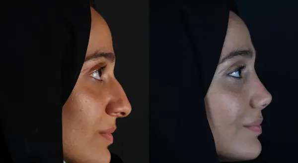 Przed i po: subtelna rhinoplastyka co to jest? Zmiana profilu nosa, poprawa harmonii twarzy.
