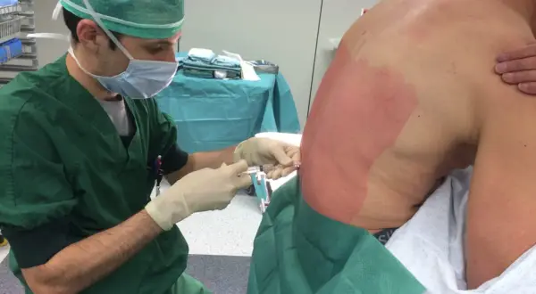 Un médecin administre une anesthésie péridurale à un patient. La zone du dos du patient est désinfectée et préparée pour l'injection.