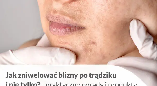 Jak usunąć blizny domowym sposobem? Skóra z widocznymi śladami po trądziku, usta i podbródek.