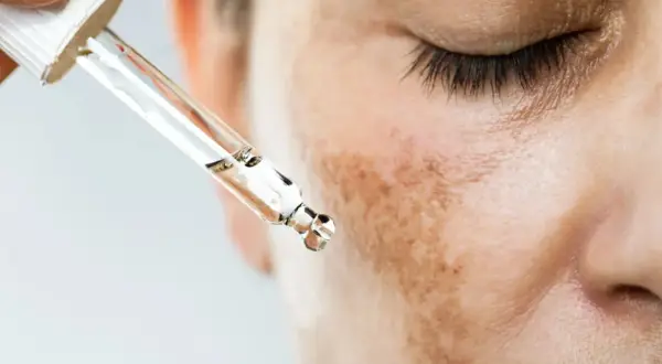 Gotas de suero aplicándose sobre manchas melasma en la mejilla de una persona.
