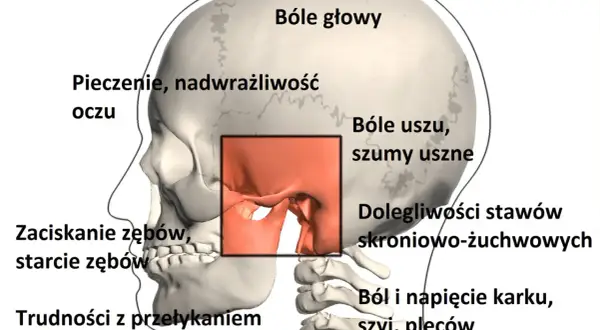 Ilustracja pokazuje objawy TMJ: bóle głowy, uszu, problemy ze stawami skroniowo-żuchwowymi, pieczenie oczu, zaciskanie zębów, trudności z przełykaniem i ból karku.