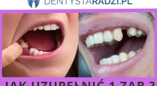 Widoczne ubytki zębów, jeden z nich jest widocznie brakujący. Pytanie brzmi: "Jak uzupełnić 1 ząb?".