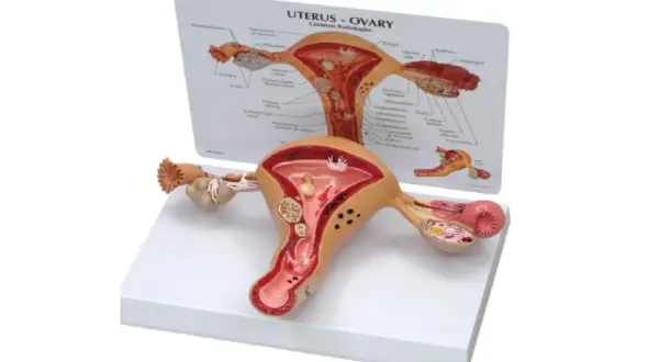 Model anatomiczny narządu rodnego kobiety z widoczną torbielą na jajniku.