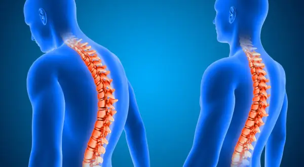 Due figure umane blu mostrano la colonna vertebrale in evidenza arancione. Una ha la schiena insaccata, l'altra una postura eretta.