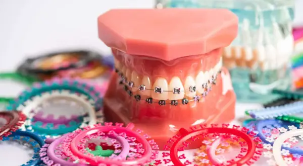 Modello di denti con apparecchio ortodontico, che ricorda l'apparecchio denti anni 80, circondato da elastici colorati.