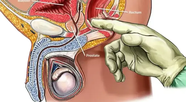 Ilustracja przedstawia badanie prostaty przez odbyt. Dłoń w rękawiczce dotyka gruczołu krokowego.