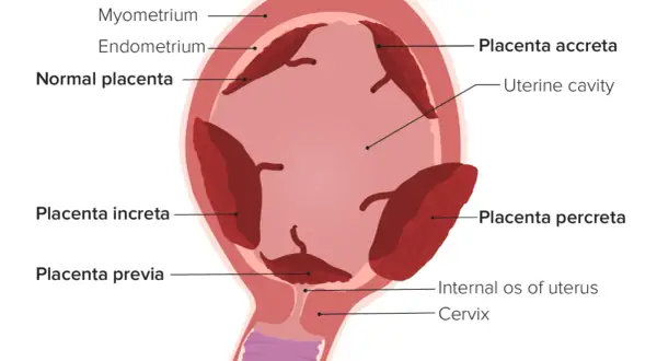 Schematische Darstellung des Uterus mit verschiedenen Plazentapositionen. Was ist die Plazenta? Sie ist ein Organ, das sich während der Schwangerschaft entwickelt.