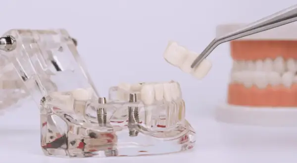 Model szczęki z implantami, na którym pęseta trzyma gotową koronę na implancie.