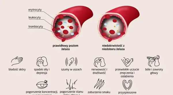 Niedokrwistość z niedoboru żelaza: porównanie poziomu żelaza, erytrocytów, leukocytów, trombocytów i objawów. Ferrytyna a żelazo.