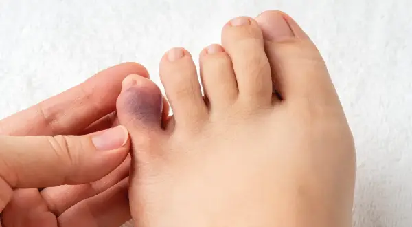 Un gros plan sur un pied montrant un orteil violet et enflé, suggérant un orteil cassé.