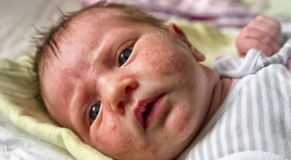Twarz niemowlaka z zaczerwienieniami i licznymi krostkami, które mogą być objawem ropnego pryszcza u niemowlaka.