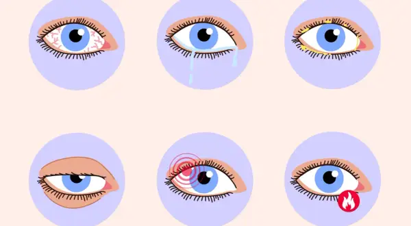 Sechs Augen zeigen verschiedene trockene Augen Symptome: Rötung, Tränen, Verkrustung, Schmerz, Brennen und ein müdes Auge.