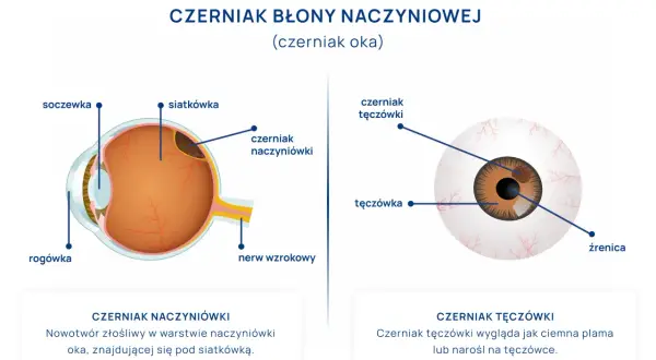 Ilustracja przekroju oka z zaznaczonym czerniakiem naczyniówki oraz widok oka z czerniakiem tęczówki.