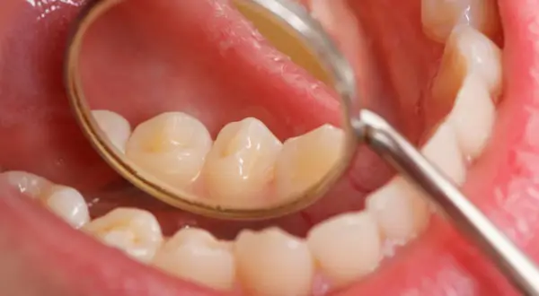 Widok jamy ustnej z lusterkiem dentystycznym. Na zębach widoczne przebarwienia, mogące świadczyć o fluoroza.