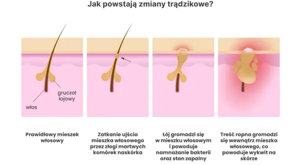 Ilustracja pokazuje powstawanie zmian trądzikowych: zatkanie mieszka włosowego, namnażanie bakterii i stan zapalny. To podstawa do zrozumienia domowych sposobów na trądzik.