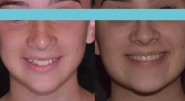 Prima e dopo: un sorriso più armonioso con una mascella pronunciata che valorizza il volto.