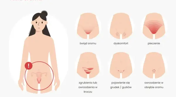 Ilustracja pokazuje wczesne objawy raka sromu: świąd, dyskomfort, pieczenie, zgrubienia, grudki i owrzodzenia.