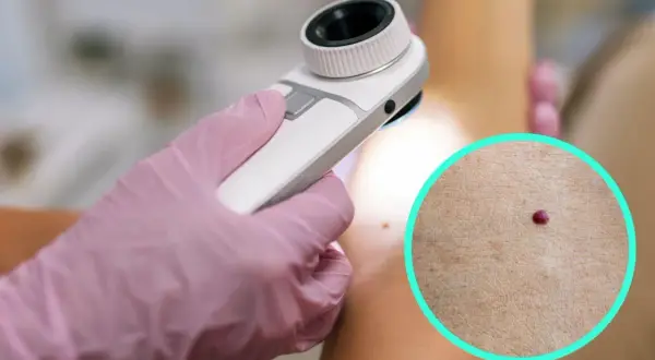 Dermatolog bada naczyniaka rubinowego za pomocą dermatoskopu.