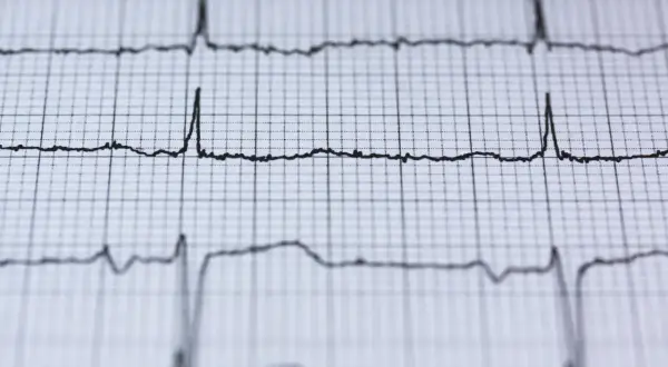 EKG pokazuje rytm serca. Czy nerwica serca wyjdzie na EKG? Zapis pokazuje fale, które mogą być interpretowane przez lekarza.