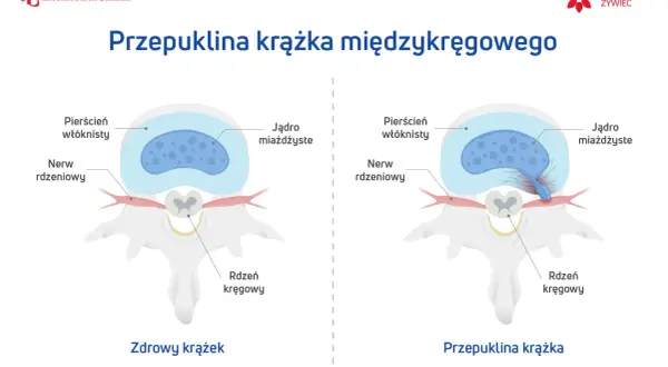 Nieleczona przepuklina kręgosłupa lędźwiowego: zdrowy krążek vs. przepuklina uciskająca nerw. Widok z góry.