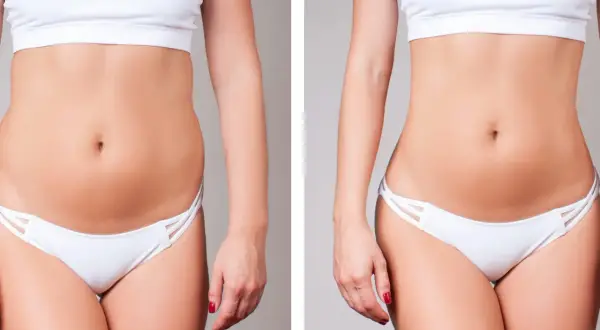 Avant/après d'une liposuccion ventre. Une silhouette affinée et une taille plus marquée après l'intervention.