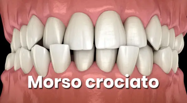 Denti bianchi e sani con un evidente morso incrociato, dove i denti superiori coprono parzialmente quelli inferiori.