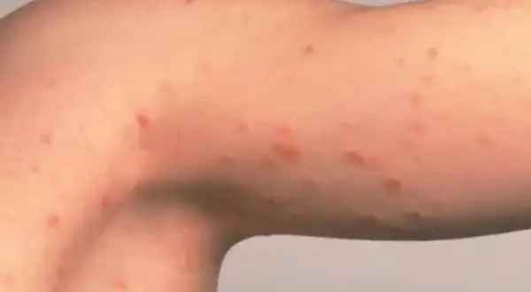 Brazo con erupción de pequeños puntos rojos, posiblemente hongos, manchas rosadas en la piel.
