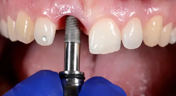 Zabieg wszczepienia implantu dentystycznego w szczękę. Widoczne są zęby, dziąsła i narzędzie stomatologiczne.