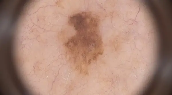 Dermatoskopische Aufnahme eines unregelmäßigen, braunen Muttermals mit feinen Gefäßen. Ein frühes Melanom zeigt sich oft so.