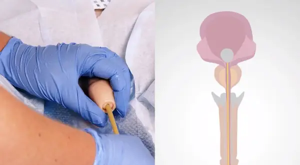 Hände mit blauen Handschuhen führen einen Katheter ein. Daneben eine schematische Darstellung des männlichen Urogenitaltrakts, die das Katheter legen illustriert.