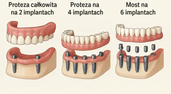 Nowoczesne protezy zębowe całkowite cena zależy od liczby implantów: na 2, 4 lub 6.
