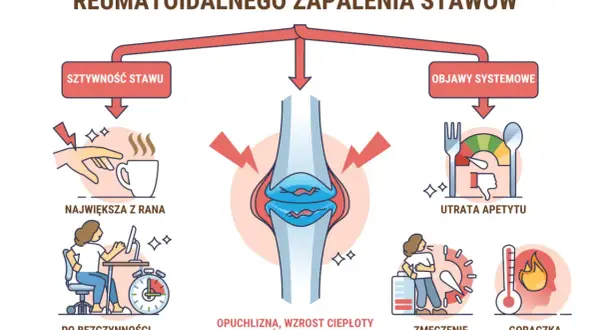 Wczesne objawy reumatoidalnego zapalenia stawów: sztywność stawu, opuchlizna, zmęczenie, gorączka, utrata apetytu.