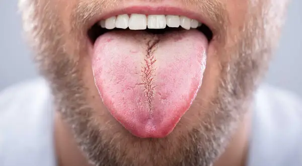 Primer plano de la boca de un hombre con barba, mostrando su lengua rosada con una **lengua blanca al final** y una grieta central.