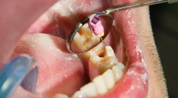 Dentysta wykonuje leczenie kanałowe jedynki. Widać narzędzie stomatologiczne w zębie i odbicie w lusterku.